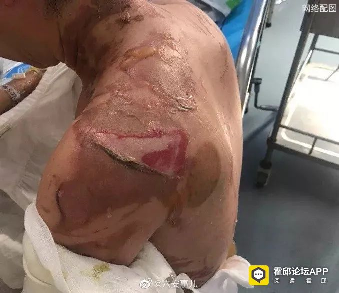 霍邱一女子美容被烧伤!司法鉴定构成十级伤残!